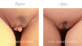 Reduction Labiaplasty / Clitoral Hood Reduction