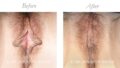 Reduction Labiaplasty / Clitoral Hood Reduction