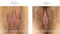 Laser Reduction Labiaplasty / Reduction of Excess Prepuce