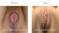 Laser Reduction Labiaplasty / Laser Perineorrhphy