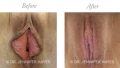 Laser Reduction Labiaplasty / Laser Vaginal Rejuvenation / Reduction of Excess Prepuce / Laser Perineorrhphy