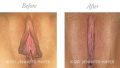 Laser Reduction Labiaplasty / Reduction of Excess Prepuce / Laser Perineorrhphy